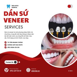 Dán sứ Veneer