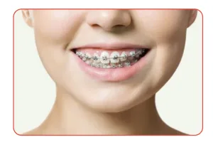 Niềng Răng mắc cài mặt ngoài