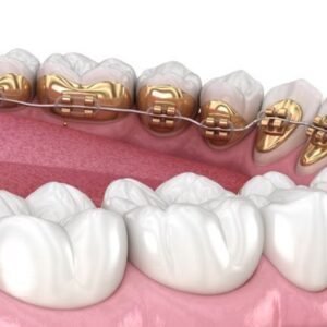 Niềng răng mắc cài mặt trong