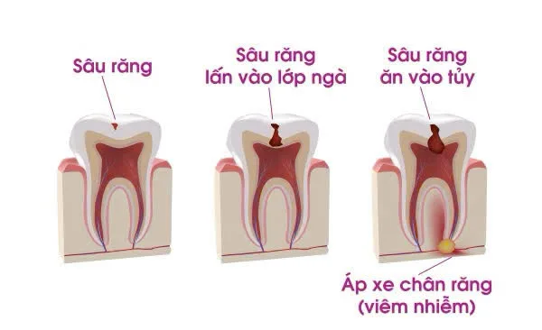 Tiến trình sâu răng