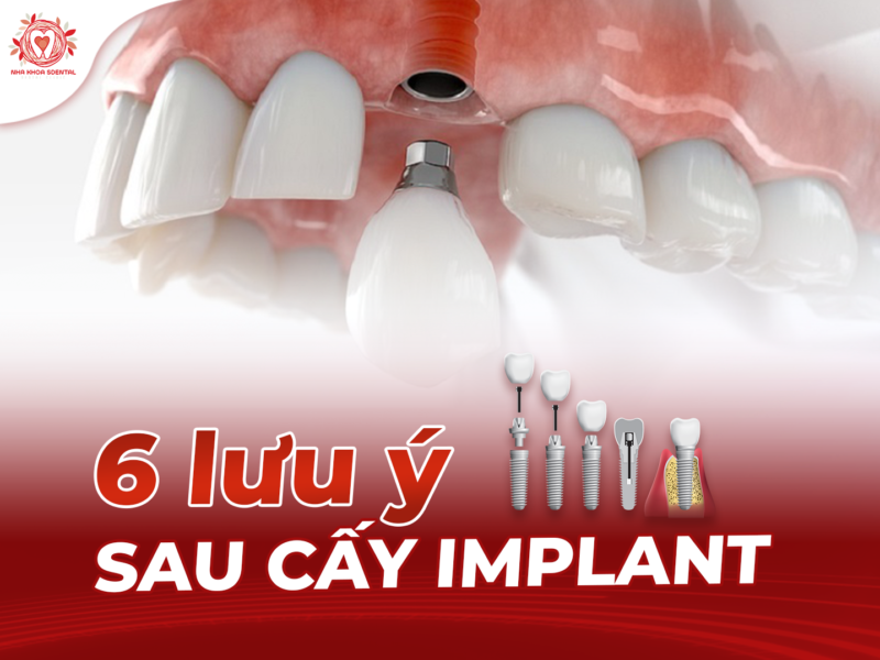6-luu-y-sau-cay-implant