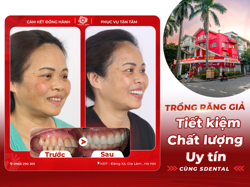 trong-rang-gia-uy-tin-tai-gia-lam-ha-noi