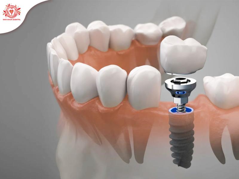 tang-tuoi-tho-rang-implant