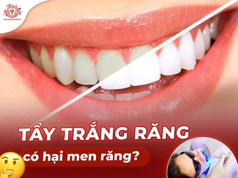 Tẩy trắng răng