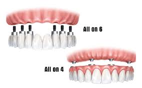 So sánh trồng răng implant all on 4 và all on 6