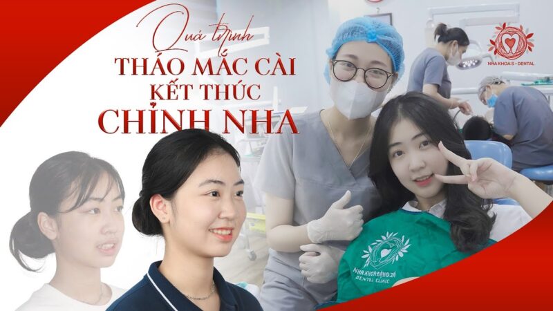 Bảng giá niềng răng thưa